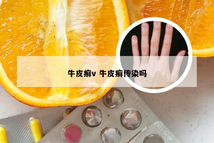 牛皮癣v 牛皮癣传染吗