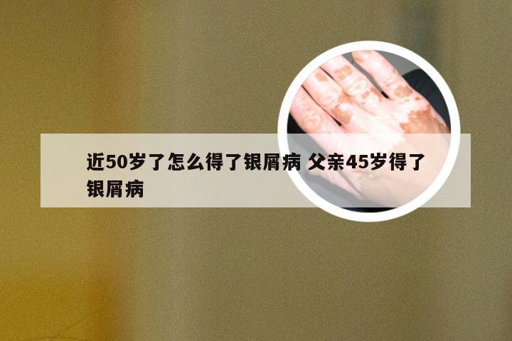 近50岁了怎么得了银屑病 父亲45岁得了银屑病