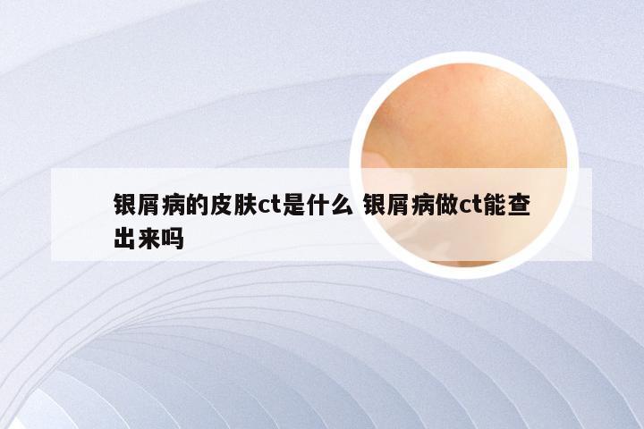 银屑病的皮肤ct是什么 银屑病做ct能查出来吗