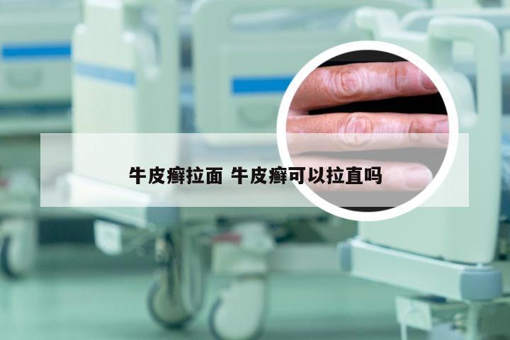 牛皮癣拉面 牛皮癣可以拉直吗
