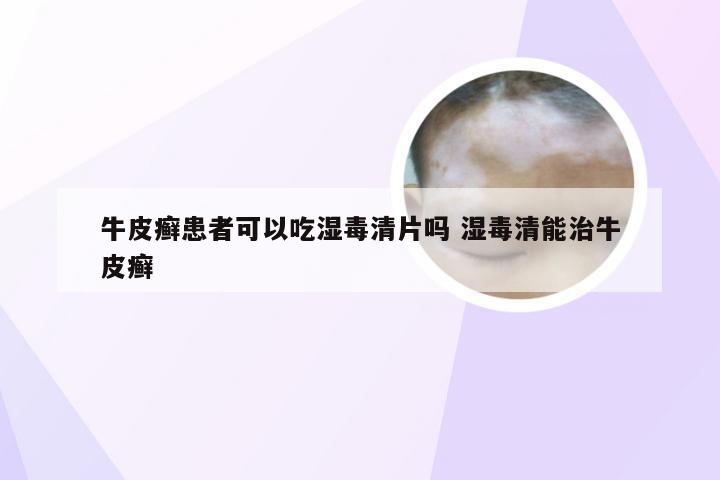牛皮癣患者可以吃湿毒清片吗 湿毒清能治牛皮癣