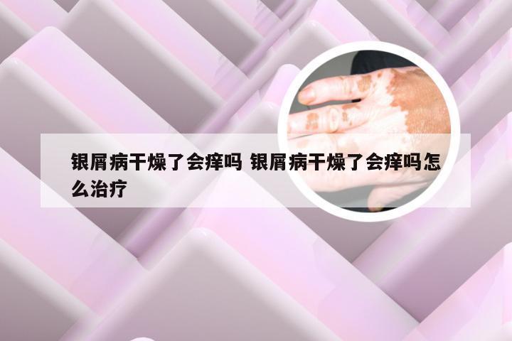 银屑病干燥了会痒吗 银屑病干燥了会痒吗怎么治疗