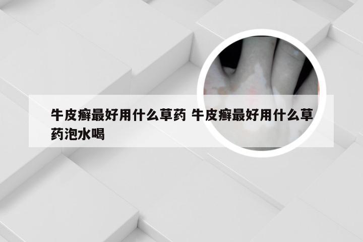 牛皮癣最好用什么草药 牛皮癣最好用什么草药泡水喝