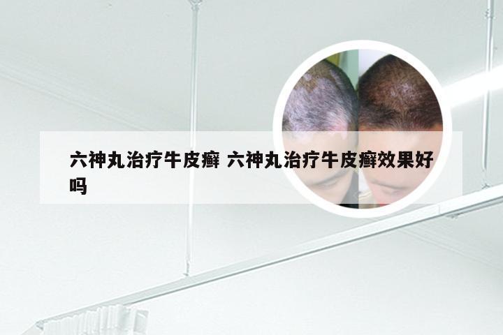 六神丸治疗牛皮癣 六神丸治疗牛皮癣效果好吗