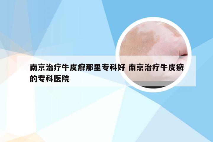 南京治疗牛皮癣那里专科好 南京治疗牛皮癣的专科医院