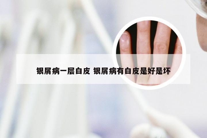 银屑病一层白皮 银屑病有白皮是好是坏
