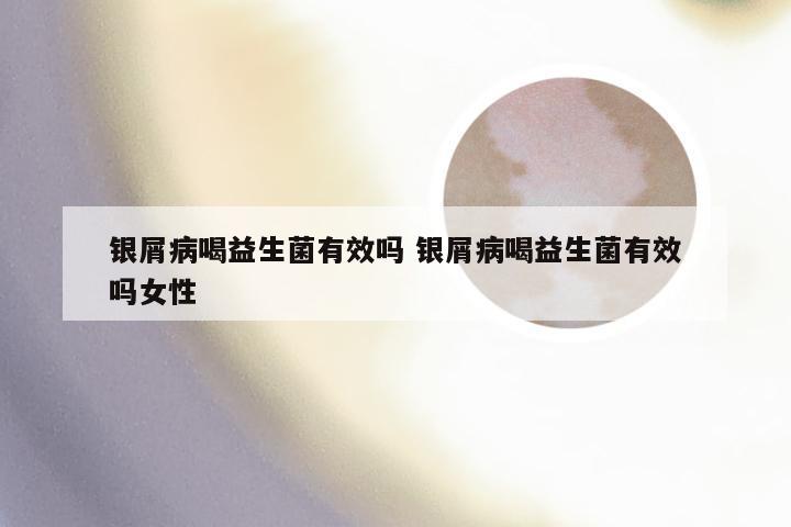 银屑病喝益生菌有效吗 银屑病喝益生菌有效吗女性