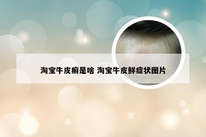 淘宝牛皮癣是啥 淘宝牛皮鲜症状图片