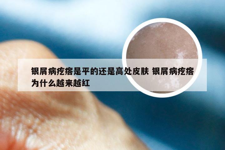 银屑病疙瘩是平的还是高处皮肤 银屑病疙瘩为什么越来越红