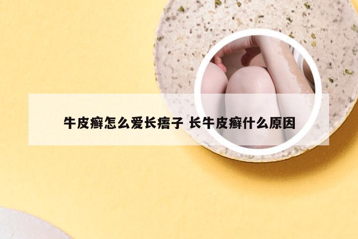 牛皮癣怎么爱长痦子 长牛皮癣什么原因
