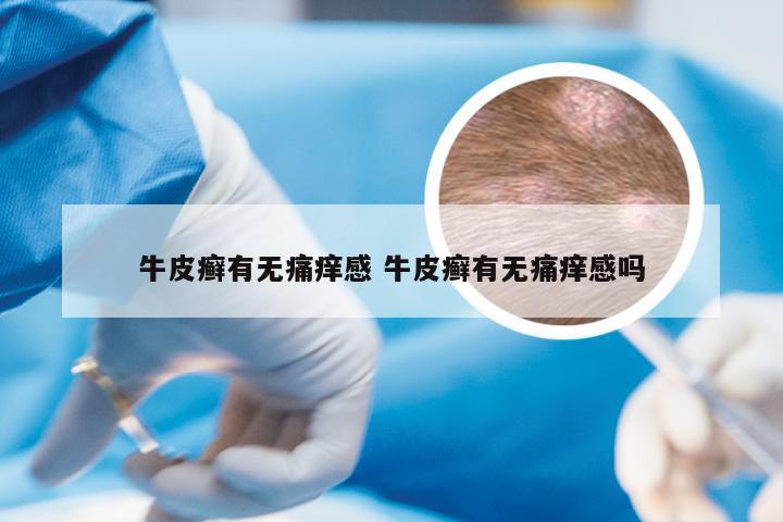 牛皮癣有无痛痒感 牛皮癣有无痛痒感吗