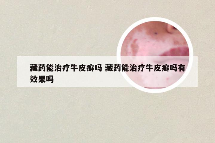 藏药能治疗牛皮癣吗 藏药能治疗牛皮癣吗有效果吗