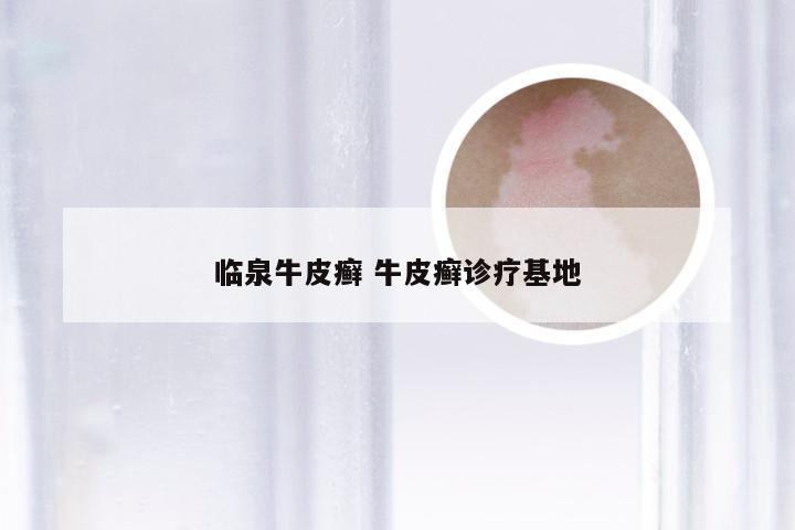 临泉牛皮癣 牛皮癣诊疗基地
