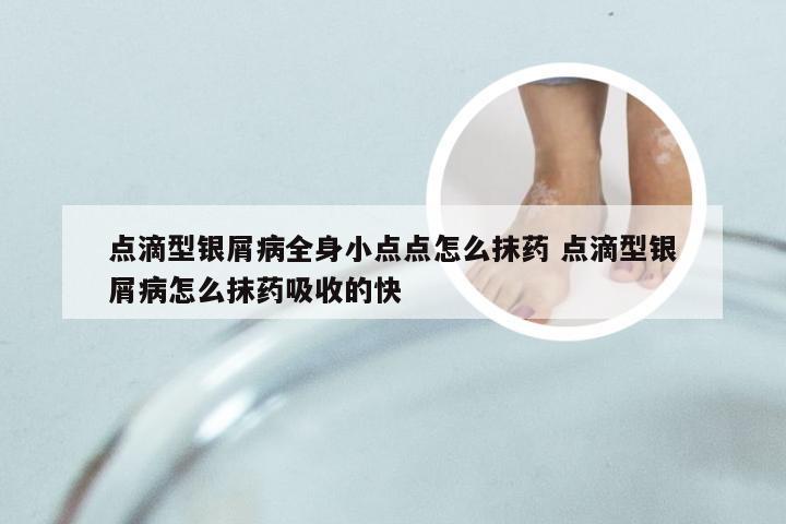 点滴型银屑病全身小点点怎么抹药 点滴型银屑病怎么抹药吸收的快