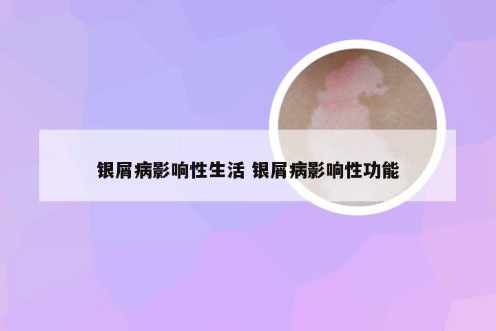 银屑病影响性生活 银屑病影响性功能