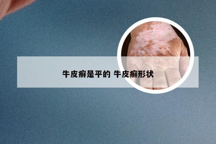 牛皮癣是平的 牛皮癣形状