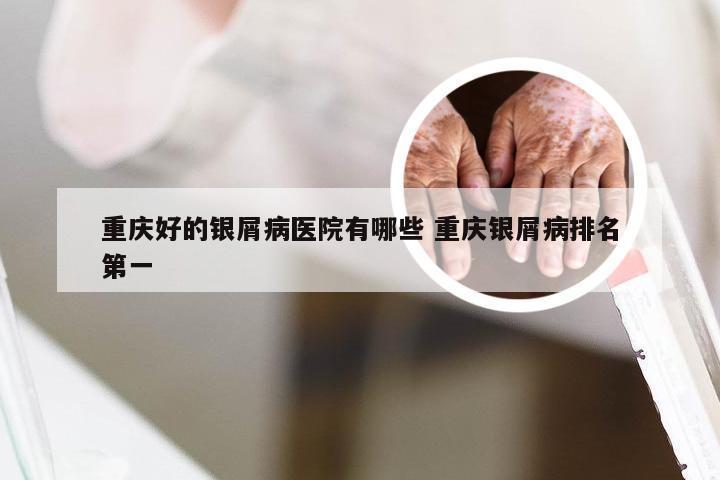 重庆好的银屑病医院有哪些 重庆银屑病排名第一