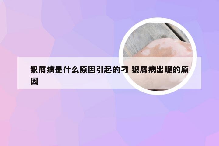 银屑病是什么原因引起的刁 银屑病出现的原因