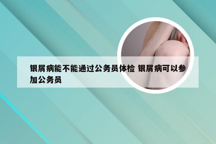 银屑病能不能通过公务员体检 银屑病可以参加公务员
