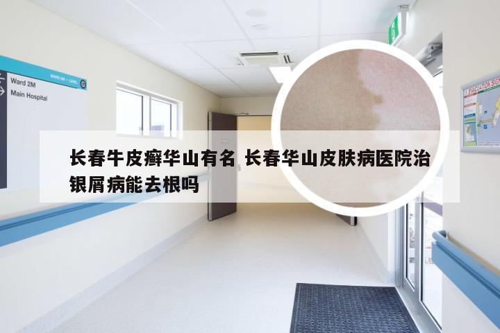 长春牛皮癣华山有名 长春华山皮肤病医院治银屑病能去根吗