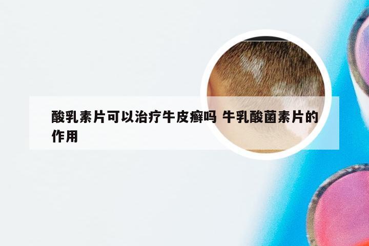 酸乳素片可以治疗牛皮癣吗 牛乳酸菌素片的作用
