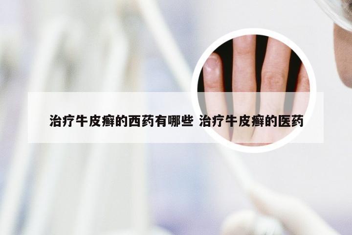 治疗牛皮癣的西药有哪些 治疗牛皮癣的医药