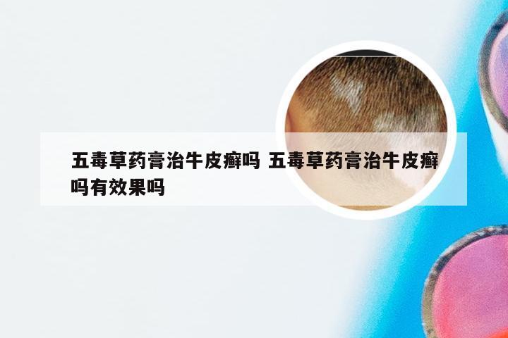五毒草药膏治牛皮癣吗 五毒草药膏治牛皮癣吗有效果吗