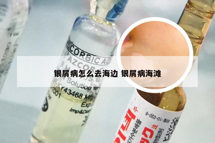 银屑病怎么去海边 银屑病海滩