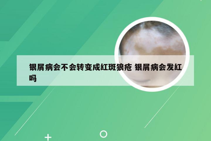 银屑病会不会转变成红斑狼疮 银屑病会发红吗