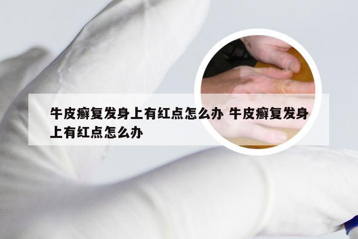 牛皮癣复发身上有红点怎么办 牛皮癣复发身上有红点怎么办