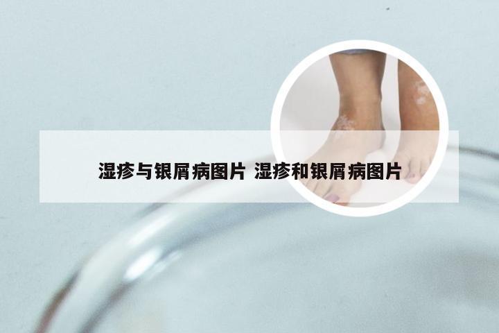 湿疹与银屑病图片 湿疹和银屑病图片