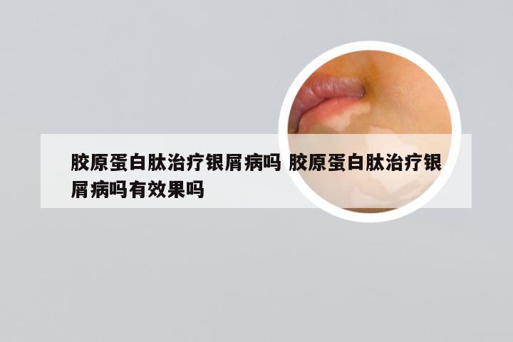 胶原蛋白肽治疗银屑病吗 胶原蛋白肽治疗银屑病吗有效果吗