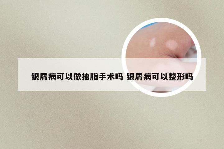银屑病可以做抽脂手术吗 银屑病可以整形吗