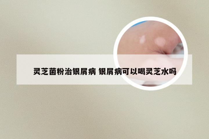 灵芝菌粉治银屑病 银屑病可以喝灵芝水吗