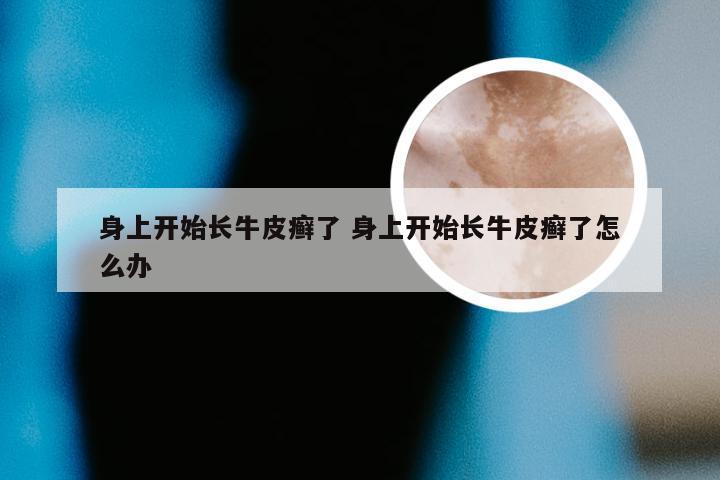 身上开始长牛皮癣了 身上开始长牛皮癣了怎么办