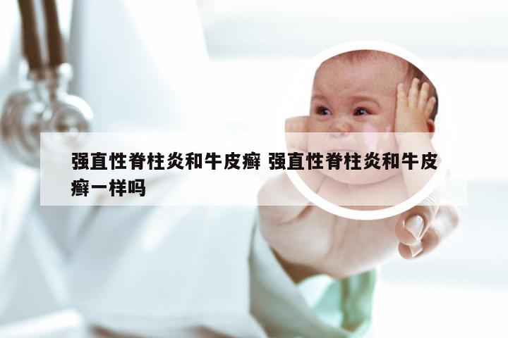 强直性脊柱炎和牛皮癣 强直性脊柱炎和牛皮癣一样吗