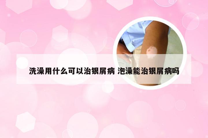 洗澡用什么可以治银屑病 泡澡能治银屑病吗