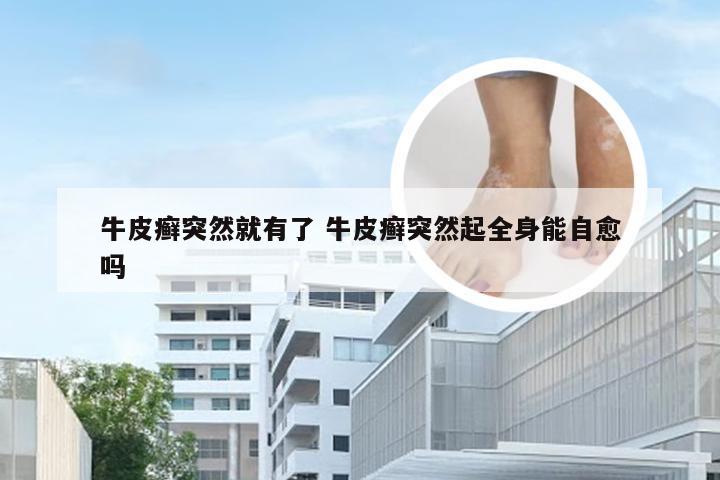 牛皮癣突然就有了 牛皮癣突然起全身能自愈吗
