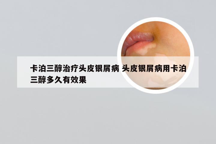 卡泊三醇治疗头皮银屑病 头皮银屑病用卡泊三醇多久有效果