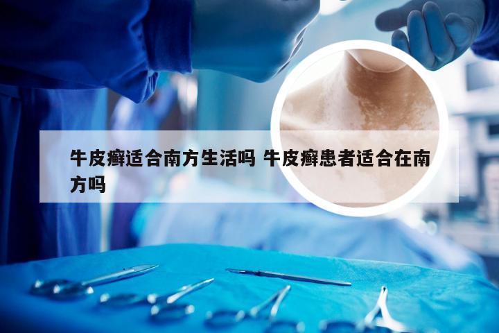 牛皮癣适合南方生活吗 牛皮癣患者适合在南方吗