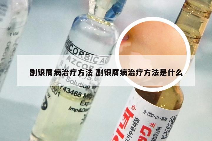 副银屑病治疗方法 副银屑病治疗方法是什么