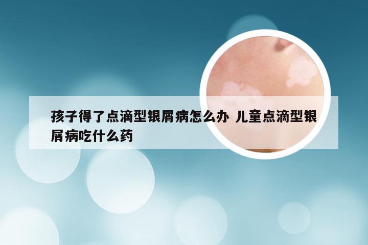 孩子得了点滴型银屑病怎么办 儿童点滴型银屑病吃什么药