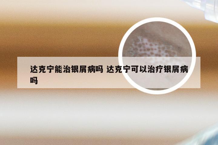 达克宁能治银屑病吗 达克宁可以治疗银屑病吗