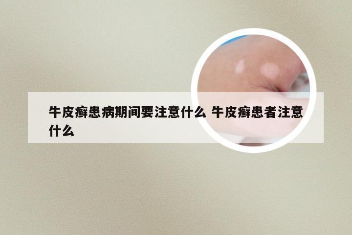 牛皮癣患病期间要注意什么 牛皮癣患者注意什么