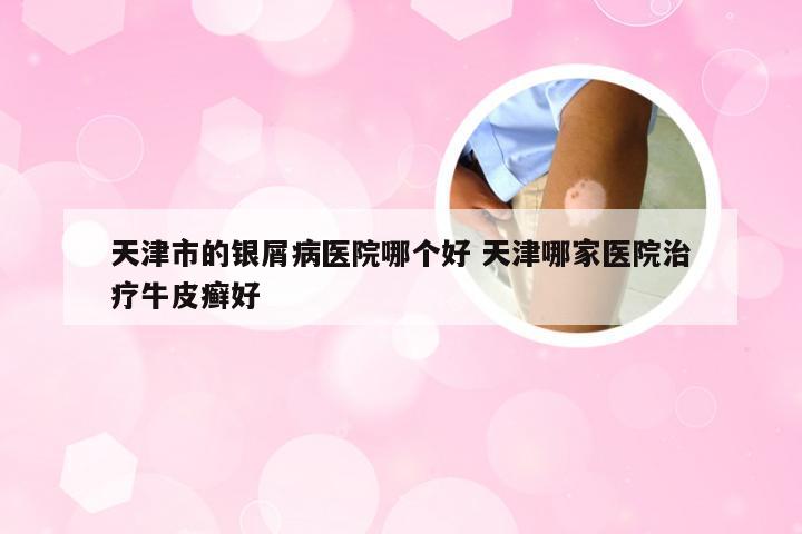 天津市的银屑病医院哪个好 天津哪家医院治疗牛皮癣好