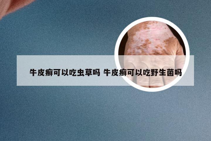 牛皮癣可以吃虫草吗 牛皮癣可以吃野生菌吗