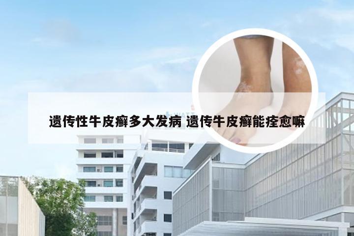 遗传性牛皮癣多大发病 遗传牛皮癣能痊愈嘛