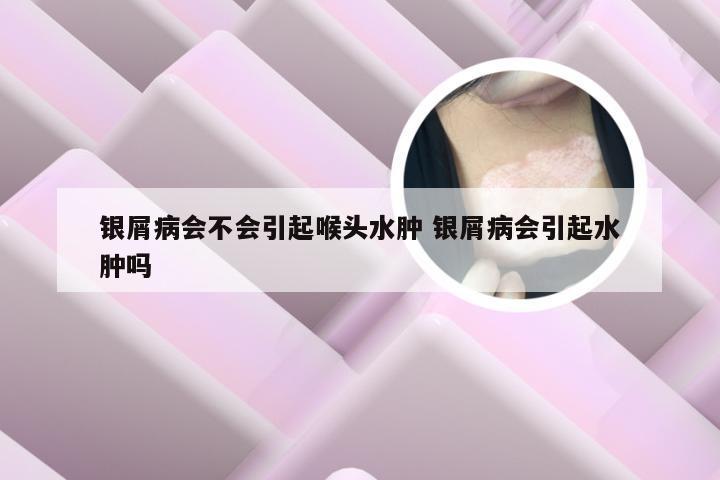 银屑病会不会引起喉头水肿 银屑病会引起水肿吗