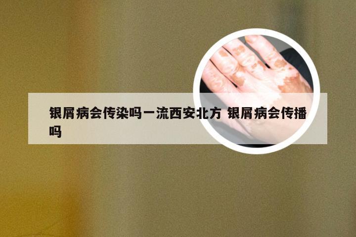 银屑病会传染吗一流西安北方 银屑病会传播吗