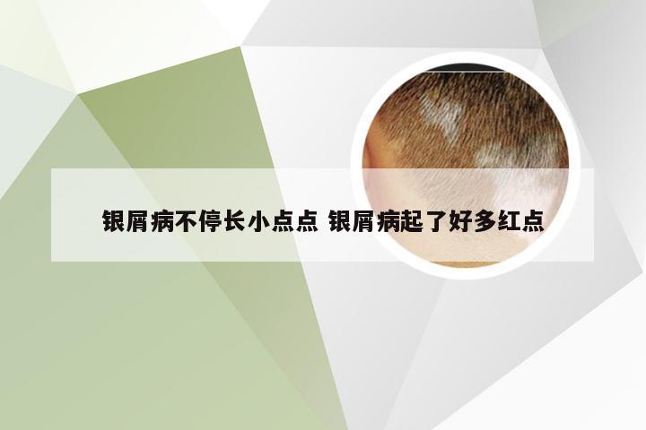 银屑病不停长小点点 银屑病起了好多红点